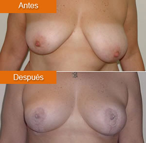 Mamoplastia de Reducci&oacute;n