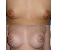 Mamoplastia de Aumento