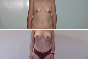 Lipolipectom&iacute;a