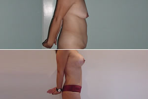 Lipolipectom&iacute;a