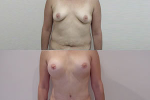 Lipolipectom&iacute;a