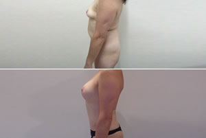 Lipolipectom&iacute;a