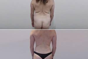 Lipolipectom&iacute;a