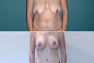 Lipolipectom&iacute;a