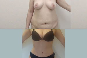 Lipolipectom&iacute;a