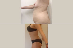 Lipolipectom&iacute;a