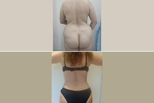 Lipolipectom&iacute;a