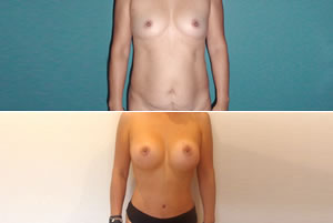 Lipolipectom&iacute;a