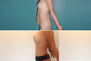 Lipolipectom&iacute;a