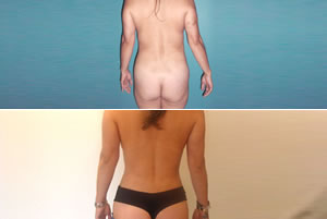 Lipolipectom&iacute;a