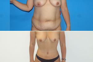 Lipolipectom&iacute;a