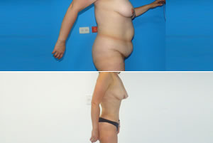 Lipolipectom&iacute;a