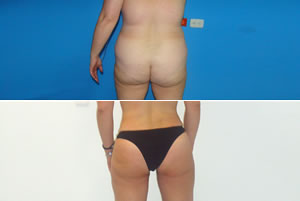 Lipolipectom&iacute;a