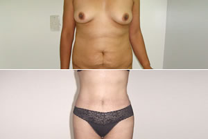 Lipolipectom&iacute;a