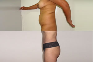 Lipolipectom&iacute;a