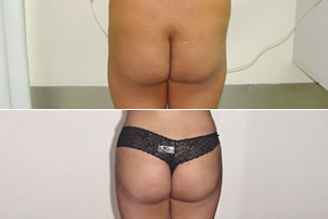 Lipolipectom&iacute;a