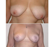 Mamoplastia de Reducci&oacute;n