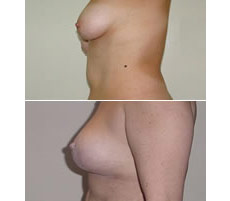 Mamoplastia de Reducci&oacute;n