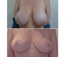 Mamoplastia de Reducci&oacute;n