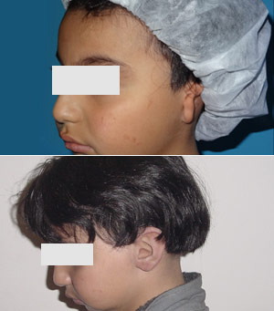 Reconstrucci&oacute;n Auricular 