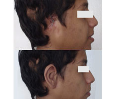 Reconstrucci&oacute;n Auricular