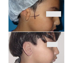 Reconstrucci&oacute;n Auricular