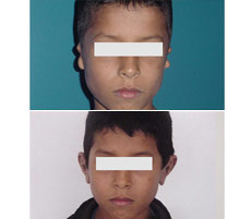 Reconstrucci&oacute;n Auricular