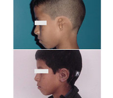 Reconstrucci&oacute;n Auricular