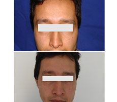 Reconstrucci&oacute;n Auricular