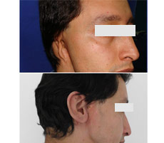 Reconstrucci&oacute;n Auricular