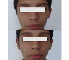 Reconstrucci&oacute;n Auricular